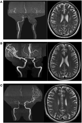 Burden of dilated perivascular spaces in patients with moyamoya disease and moyamoya syndrome is related to middle cerebral artery stenosis